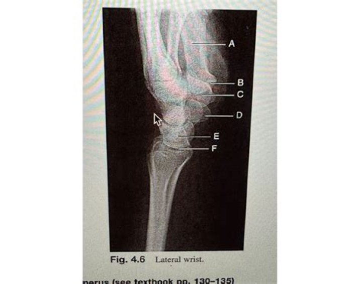 Lateral Wrist Quiz