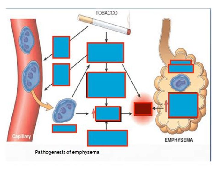 Pathogenesis of emphysema Quiz